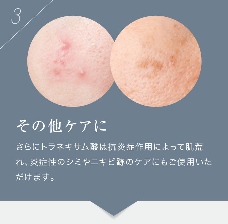 薬用美白クリーム】 顔にできてしまった濃いシミに ホワイトップ 28g